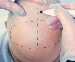 What Are the Different Types of Hair Transplant Techniques?